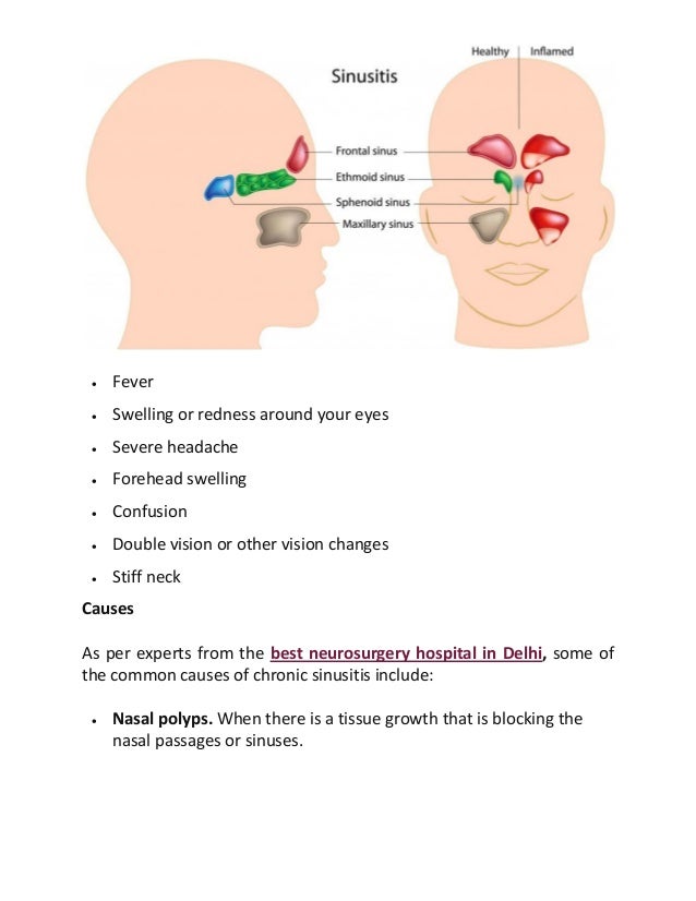 Pdf Sinusitis 2019