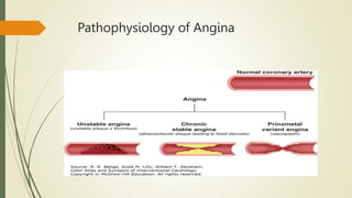 Pathophysiology of Angina
 