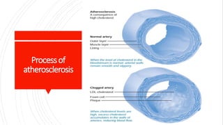 Processof
atherosclerosis
 