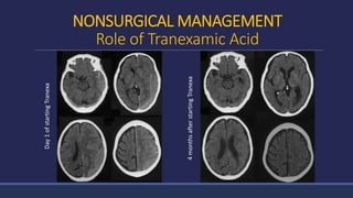 NONSURGICAL MANAGEMENT
Role of Tranexamic AcidDay1ofstartingTranexa
4monthsafterstartingTranexa
 