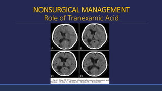 NONSURGICAL MANAGEMENT
Role of Tranexamic Acid
 