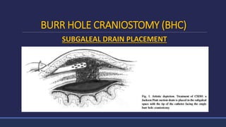 BURR HOLE CRANIOSTOMY (BHC)
SUBGALEAL DRAIN PLACEMENT
 