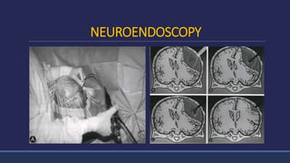 NEUROENDOSCOPY
 