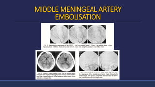MIDDLE MENINGEAL ARTERY
EMBOLISATION
 