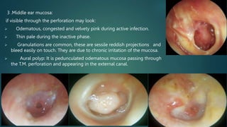 3 .Middle ear mucosa:
if visible through the perforation may look:
 Odematous, congested and velvety pink during active infection.
 Thin pale during the inactive phase.
 Granulations are common, these are sessile reddish projections and
bleed easily on touch. They are due to chronic irritation of the mucosa.
 Aural polyp: It is pedunculated odematous mucosa passing through
the T.M. perforation and appearing in the external canal.
 