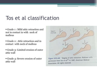 Tos et al classification
 Grade 1 : Mild attic retraction and
not in contact in with neck of
malleus
 Grade 2 : Attic retraction and in
contact with neck of malleus
 Grade 3: Limited erosion of outer
attic wall
 Grade 4: Severe erosion of outer
attic wall
 