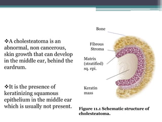 Fibrous
Stroma
Matrix
(stratified)
sq. epi.
Keratin
mass
Figure 11.1 Schematic structure of
cholesteatoma.
Bone
A cholesteatoma is an
abnormal, non cancerous,
skin growth that can develop
in the middle ear, behind the
eardrum.
It is the presence of
keratinizing squamous
epithelium in the middle ear
which is usually not present.
 