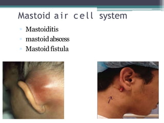 Mastoid a i r c e l l system
 Mastoiditis
 mastoidabscess
 Mastoidfistula
 