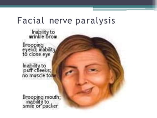 Facial nerve paralysis
 
