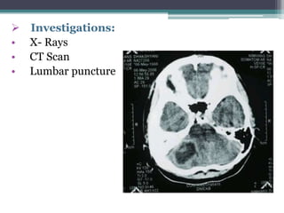  Investigations:
• X- Rays
• CT Scan
• Lumbar puncture
 