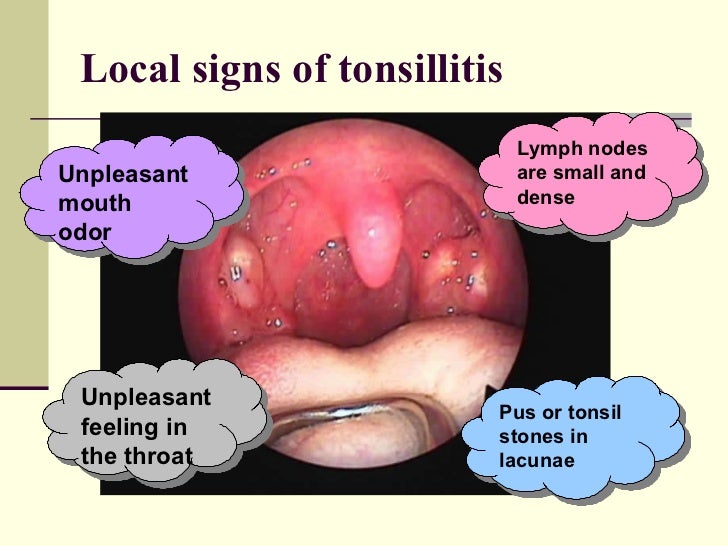 Chronic Tonsillitis