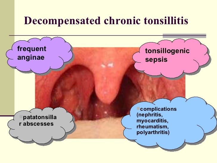 Chronic Tonsillitis