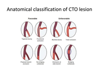 Chronic total occlusion | PPTX