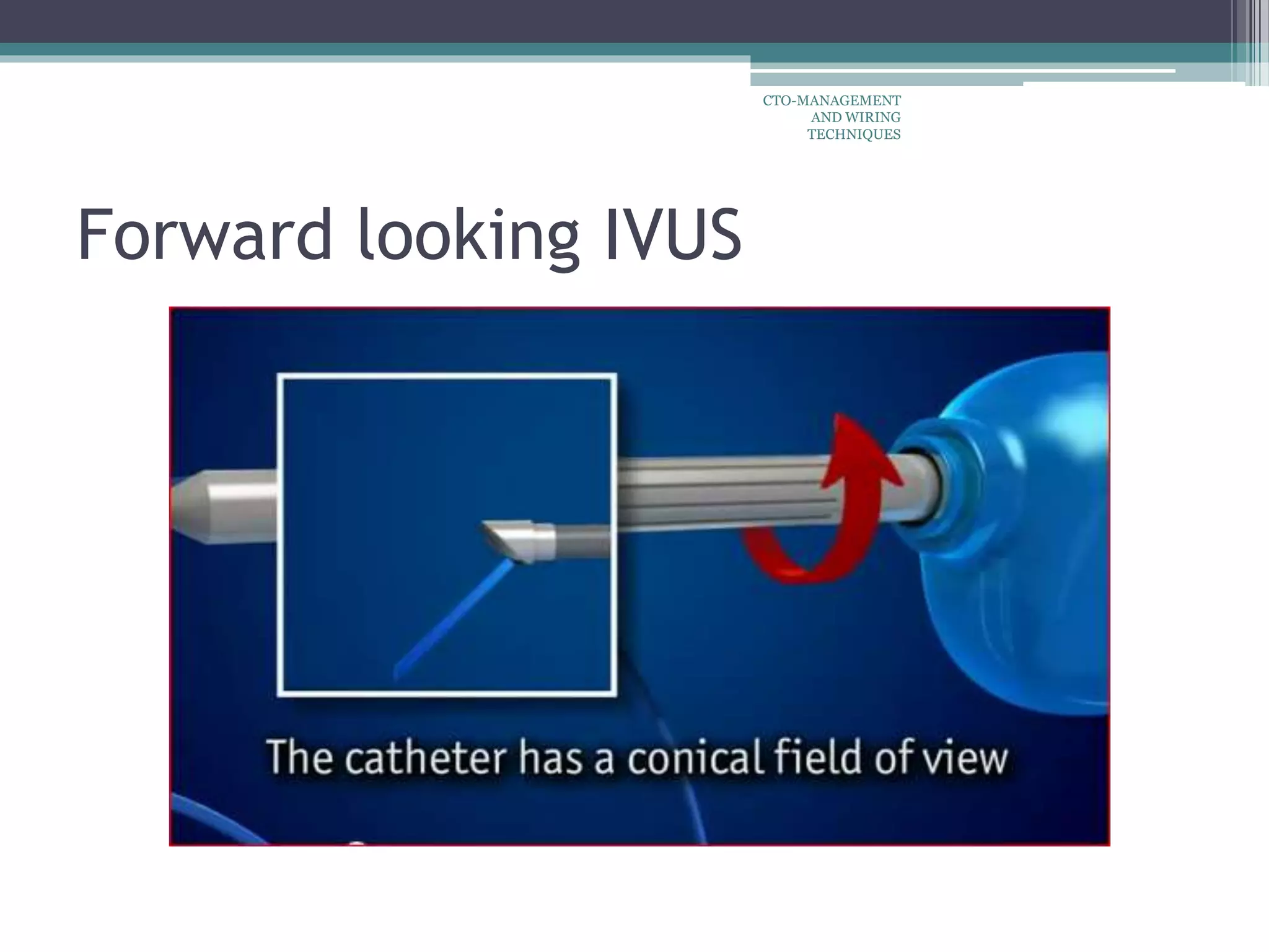 Forward looking IVUS
CTO-MANAGEMENT
AND WIRING
TECHNIQUES
 