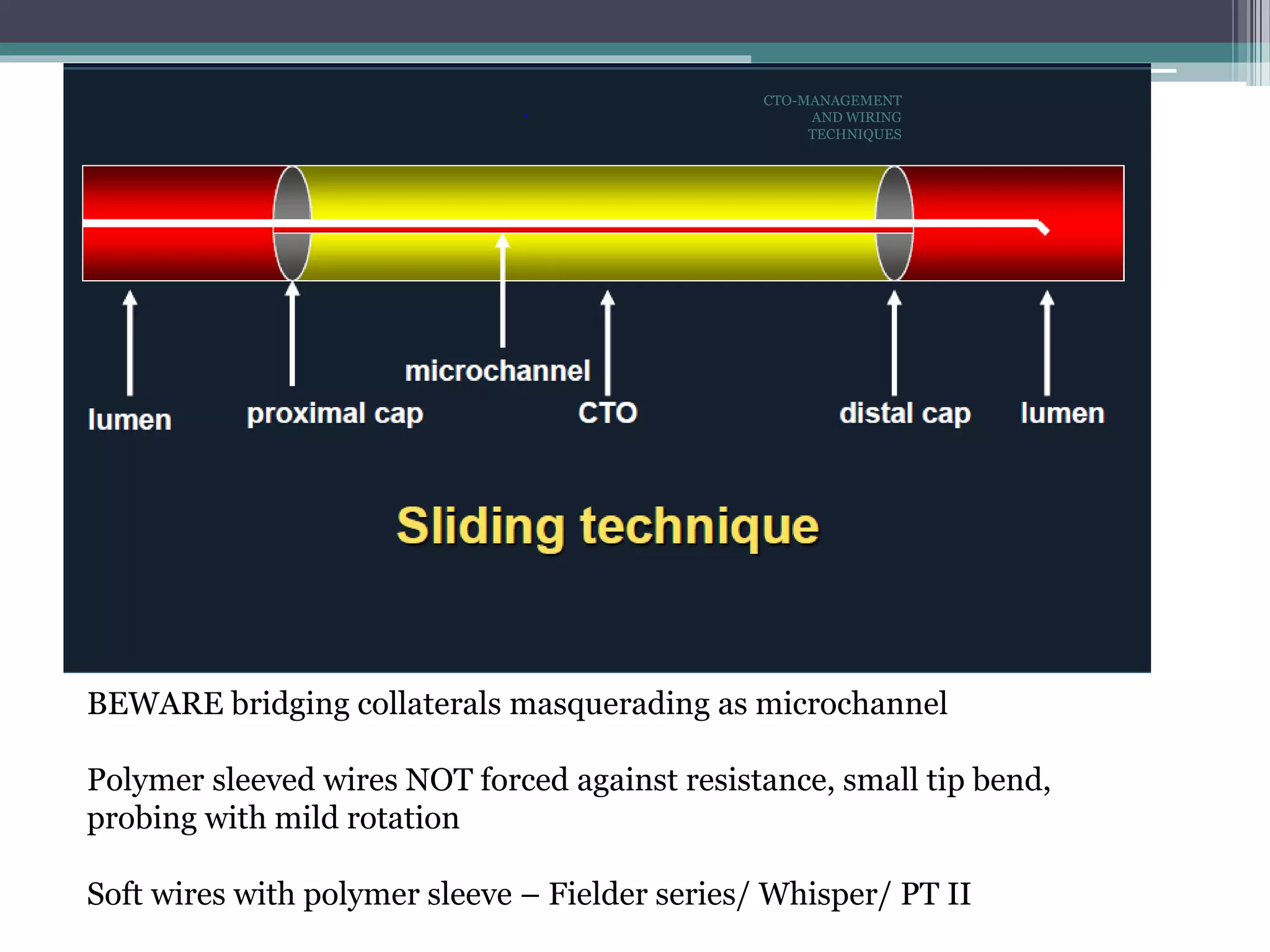 BEWARE bridging collaterals masquerading as microchannel
Polymer sleeved wires NOT forced against resistance, small tip bend,
probing with mild rotation
Soft wires with polymer sleeve – Fielder series/ Whisper/ PT II
CTO-MANAGEMENT
AND WIRING
TECHNIQUES
 