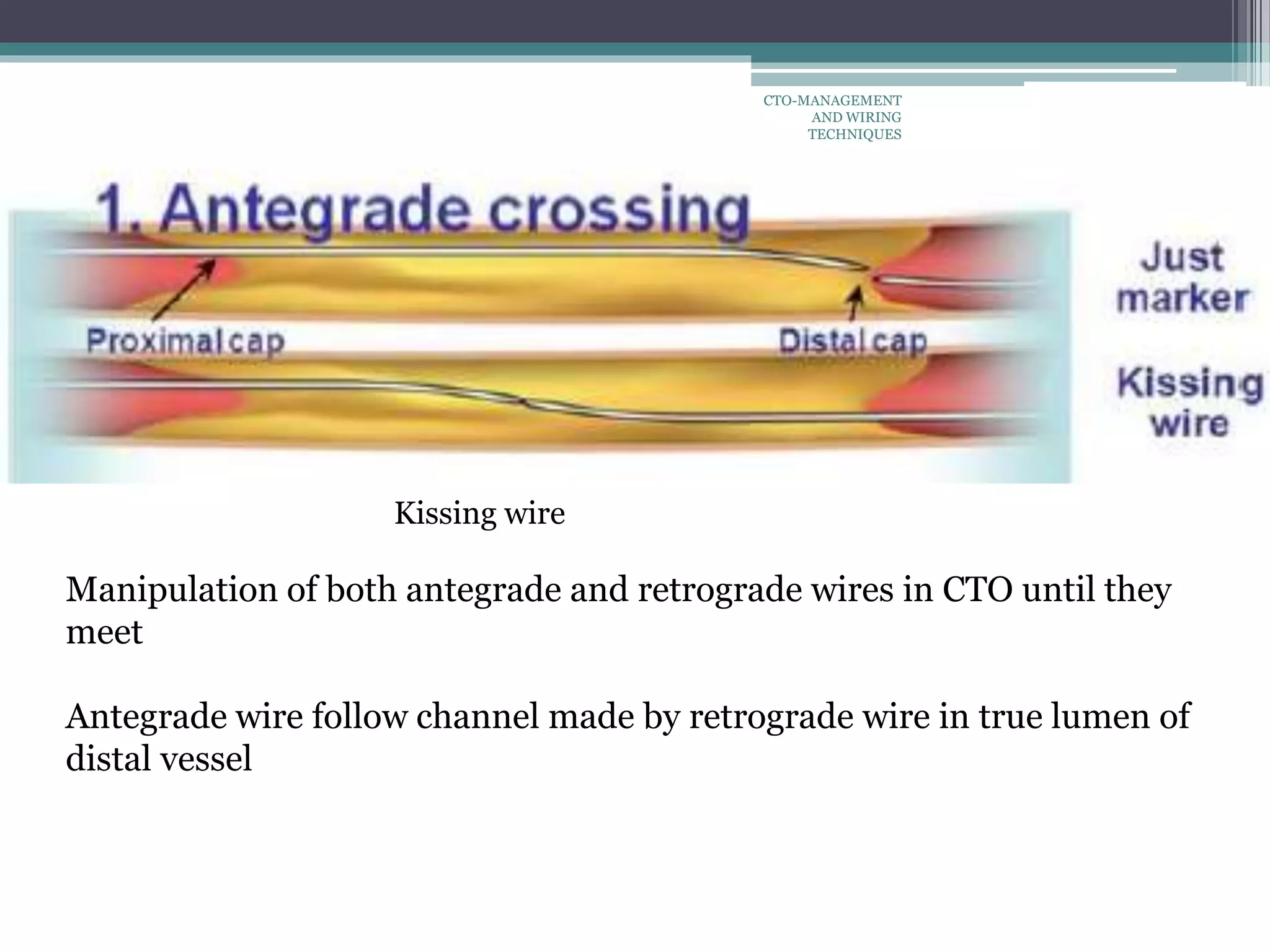 Kissing wire
Manipulation of both antegrade and retrograde wires in CTO until they
meet
Antegrade wire follow channel made by retrograde wire in true lumen of
distal vessel
CTO-MANAGEMENT
AND WIRING
TECHNIQUES
 