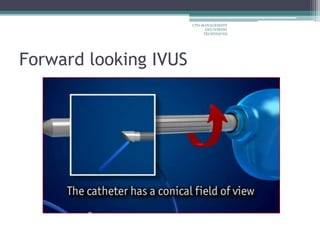 Forward looking IVUS
CTO-MANAGEMENT
AND WIRING
TECHNIQUES
 