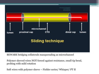 BEWARE bridging collaterals masquerading as microchannel
Polymer sleeved wires NOT forced against resistance, small tip bend,
probing with mild rotation
Soft wires with polymer sleeve – Fielder series/ Whisper/ PT II
CTO-MANAGEMENT
AND WIRING
TECHNIQUES
 