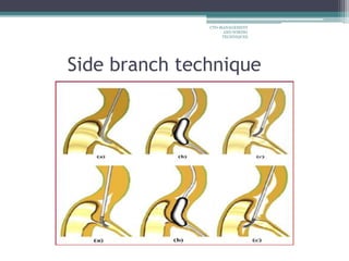 Side branch technique
CTO-MANAGEMENT
AND WIRING
TECHNIQUES
 
