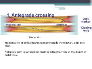 Kissing wire
Manipulation of both antegrade and retrograde wires in CTO until they
meet
Antegrade wire follow channel made by retrograde wire in true lumen of
distal vessel
CTO-MANAGEMENT
AND WIRING
TECHNIQUES
 
