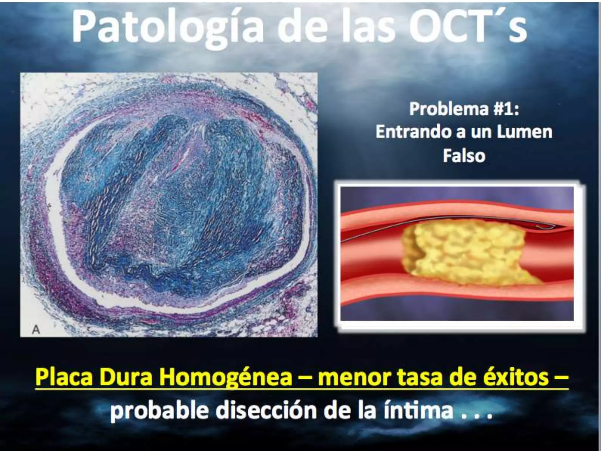 INTERVENTIONAL TECHNIQUES IN CHRONIC TOTAL OCCLUSIONS