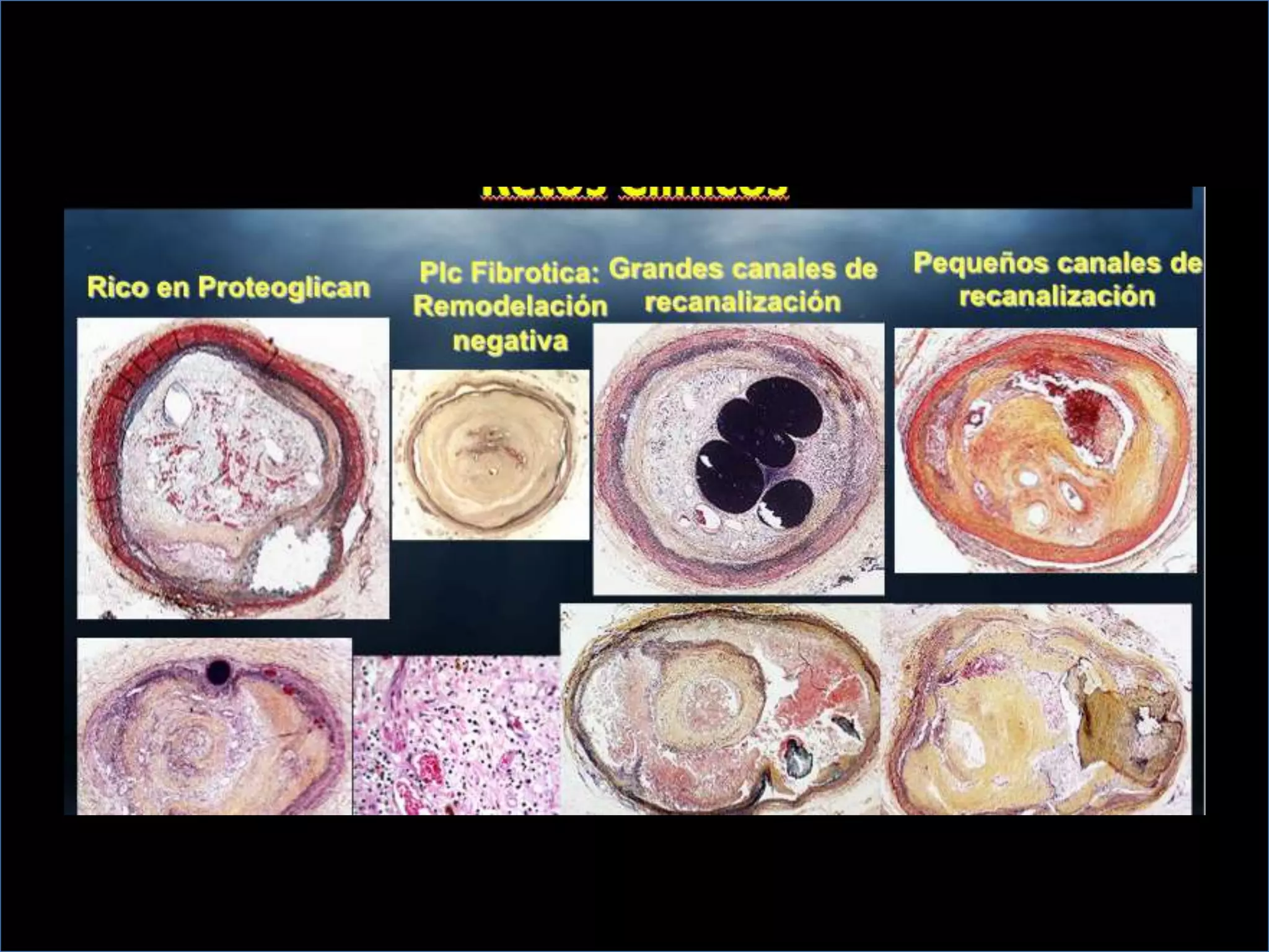 INTERVENTIONAL TECHNIQUES IN CHRONIC TOTAL OCCLUSIONS