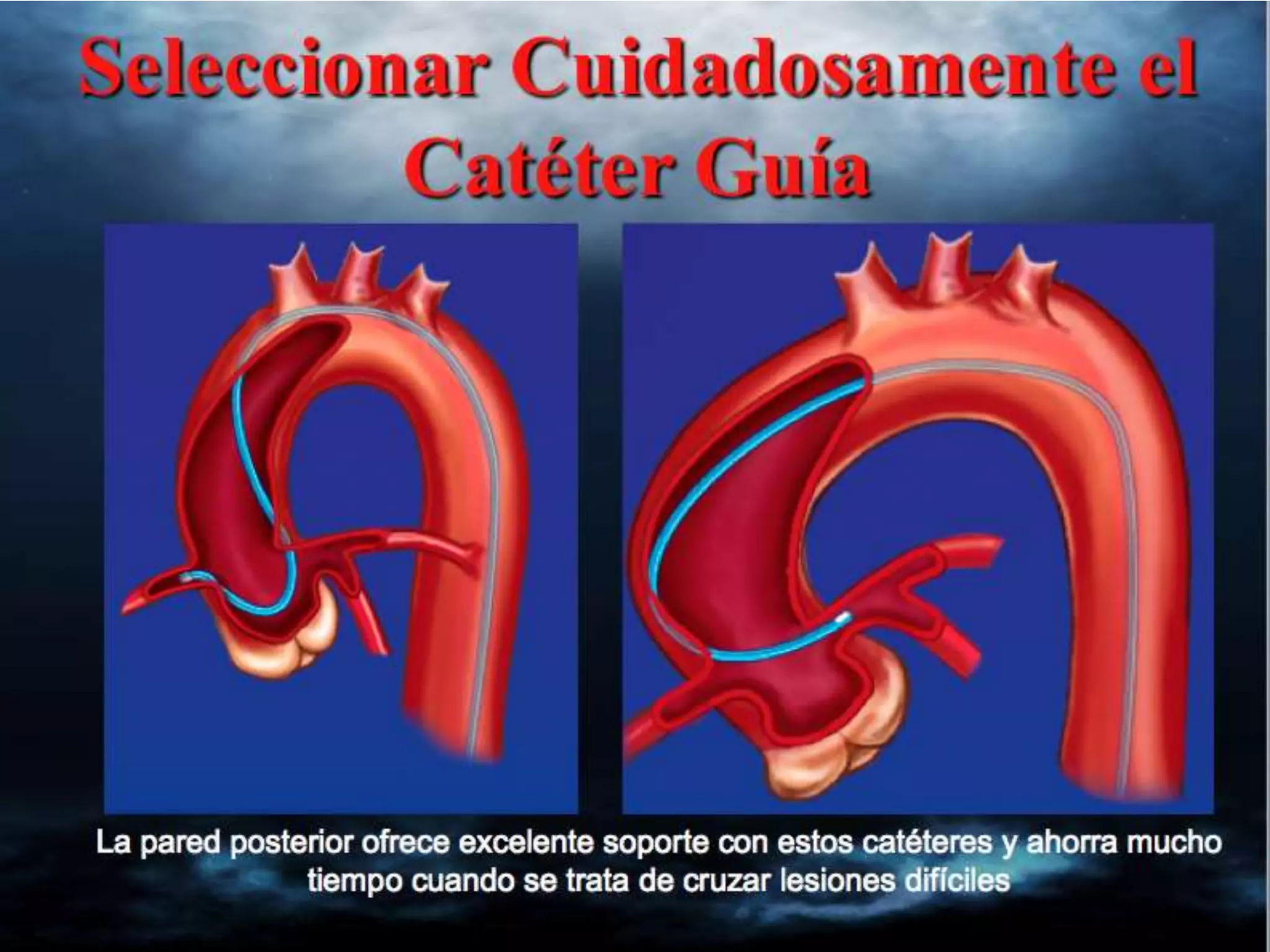 INTERVENTIONAL TECHNIQUES IN CHRONIC TOTAL OCCLUSIONS
