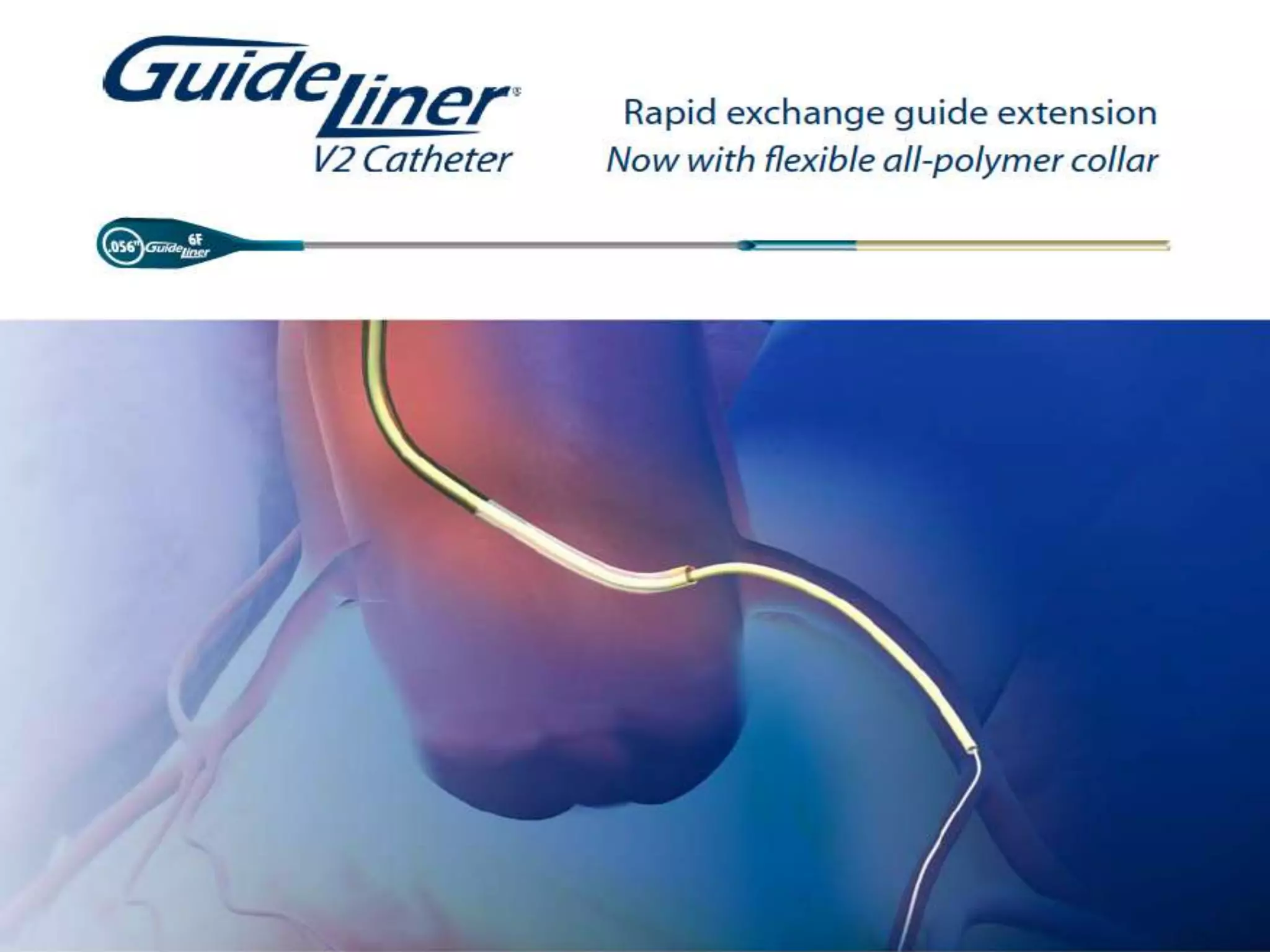 INTERVENTIONAL TECHNIQUES IN CHRONIC TOTAL OCCLUSIONS