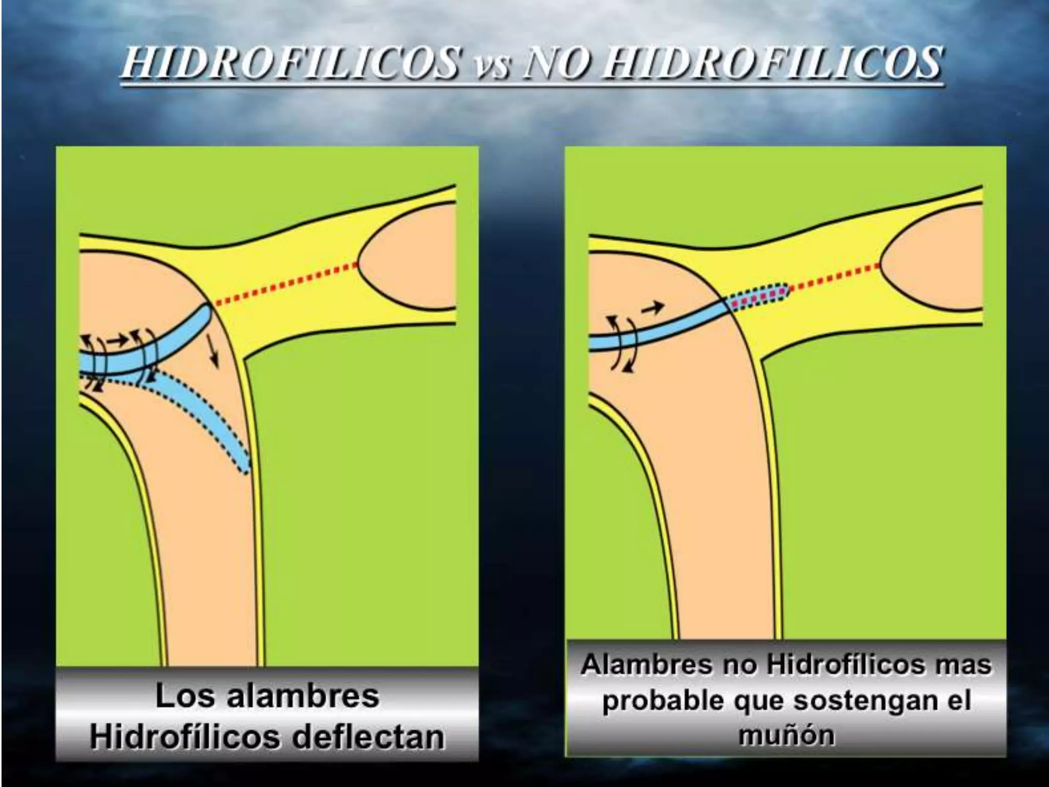 INTERVENTIONAL TECHNIQUES IN CHRONIC TOTAL OCCLUSIONS