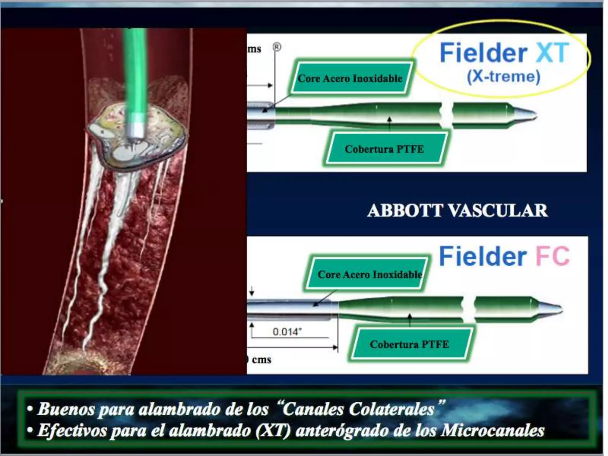 INTERVENTIONAL TECHNIQUES IN CHRONIC TOTAL OCCLUSIONS