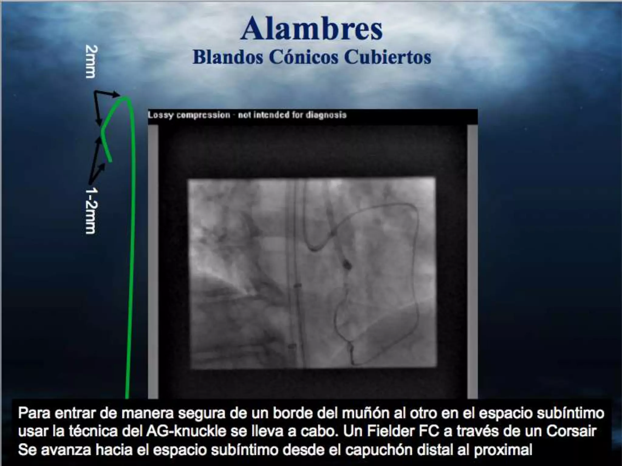 INTERVENTIONAL TECHNIQUES IN CHRONIC TOTAL OCCLUSIONS