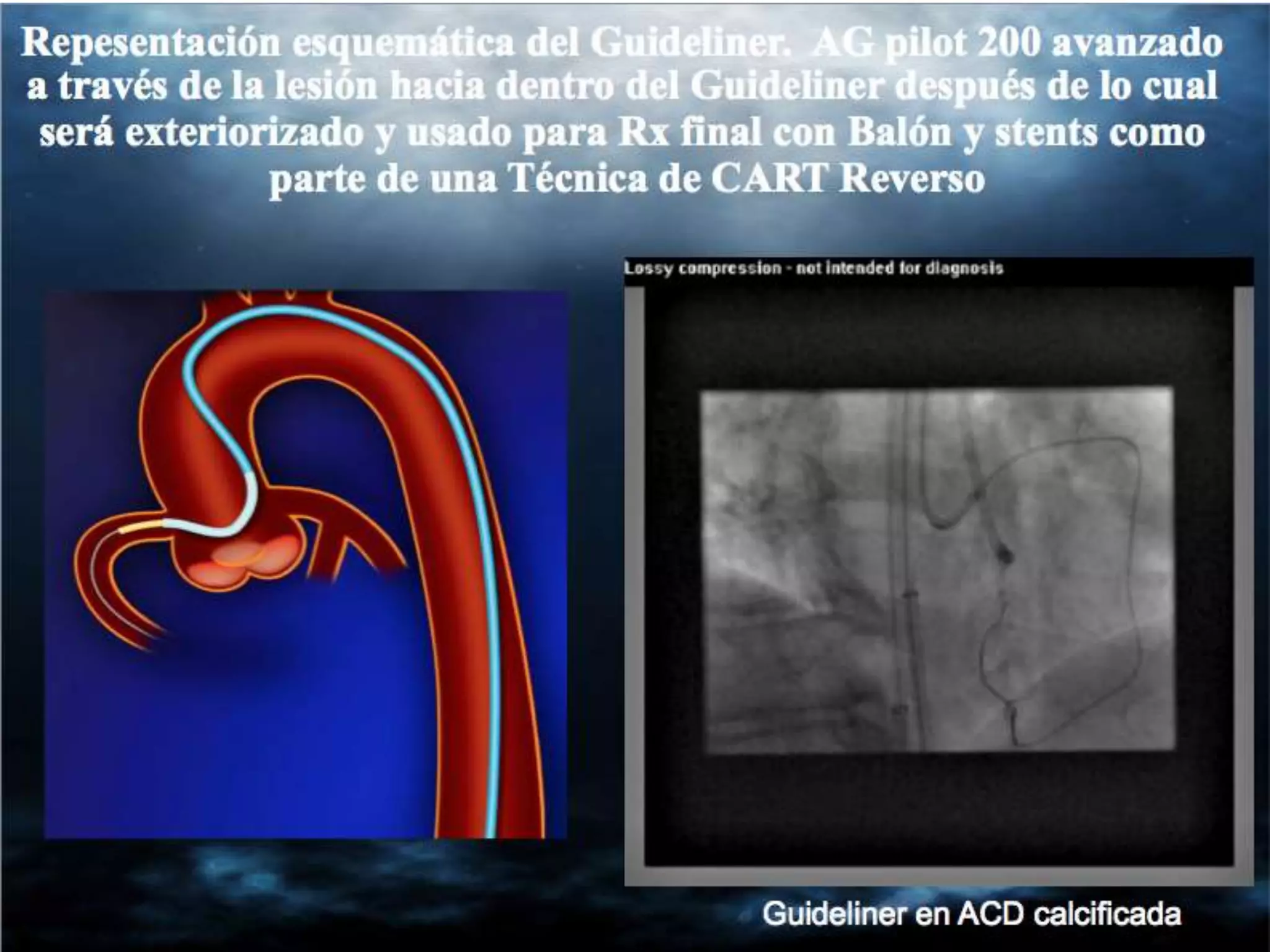 INTERVENTIONAL TECHNIQUES IN CHRONIC TOTAL OCCLUSIONS