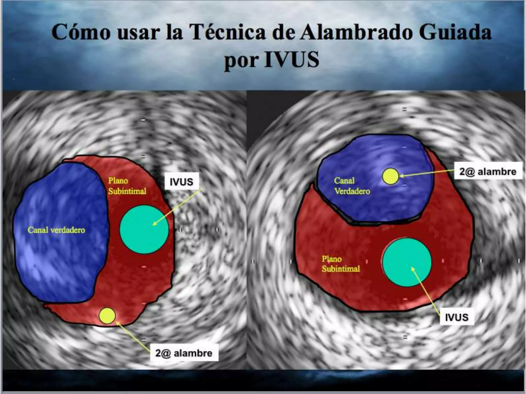INTERVENTIONAL TECHNIQUES IN CHRONIC TOTAL OCCLUSIONS