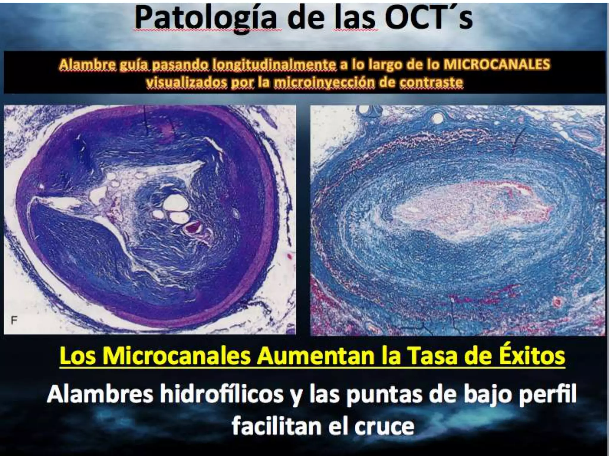INTERVENTIONAL TECHNIQUES IN CHRONIC TOTAL OCCLUSIONS