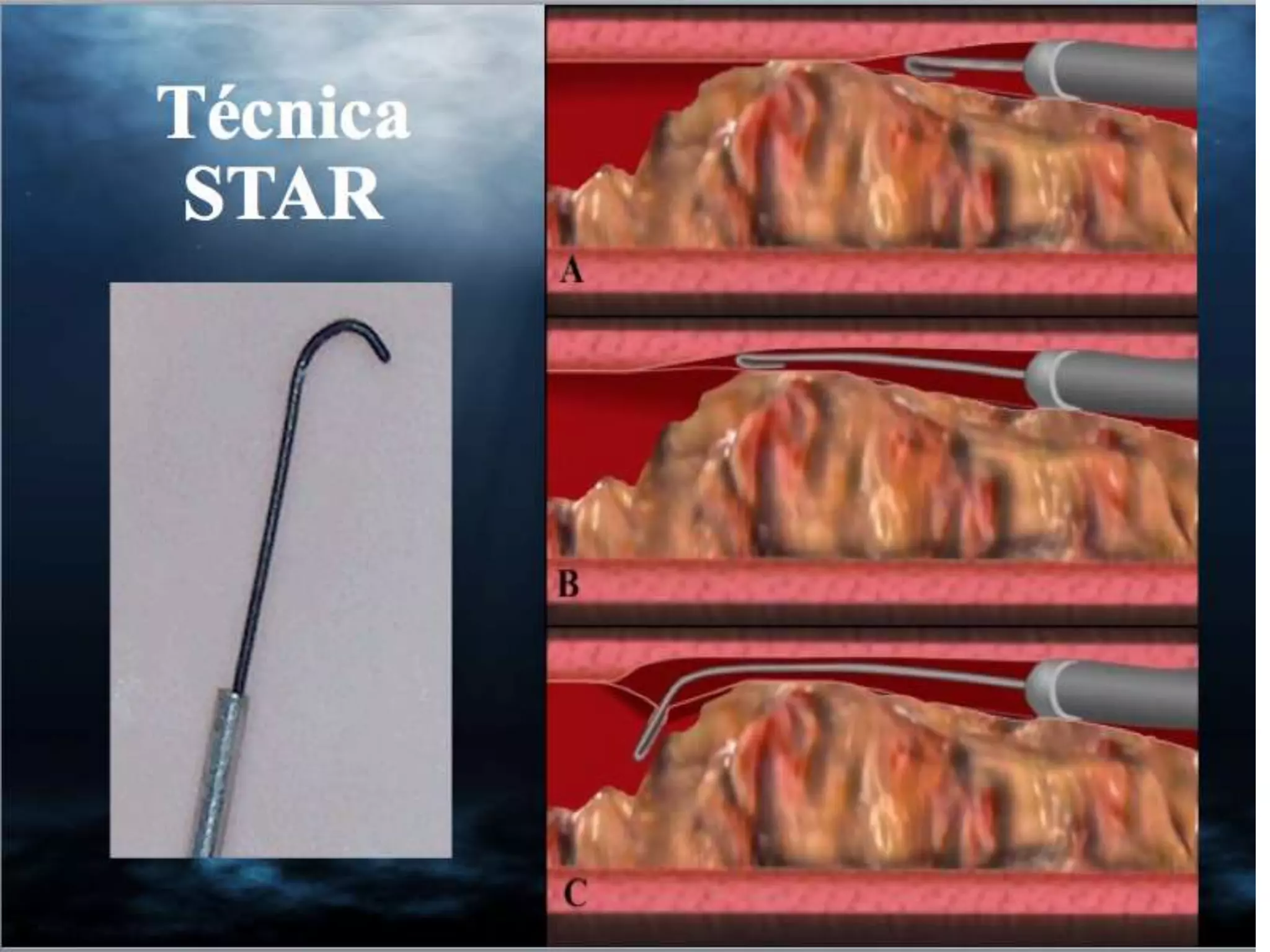 INTERVENTIONAL TECHNIQUES IN CHRONIC TOTAL OCCLUSIONS