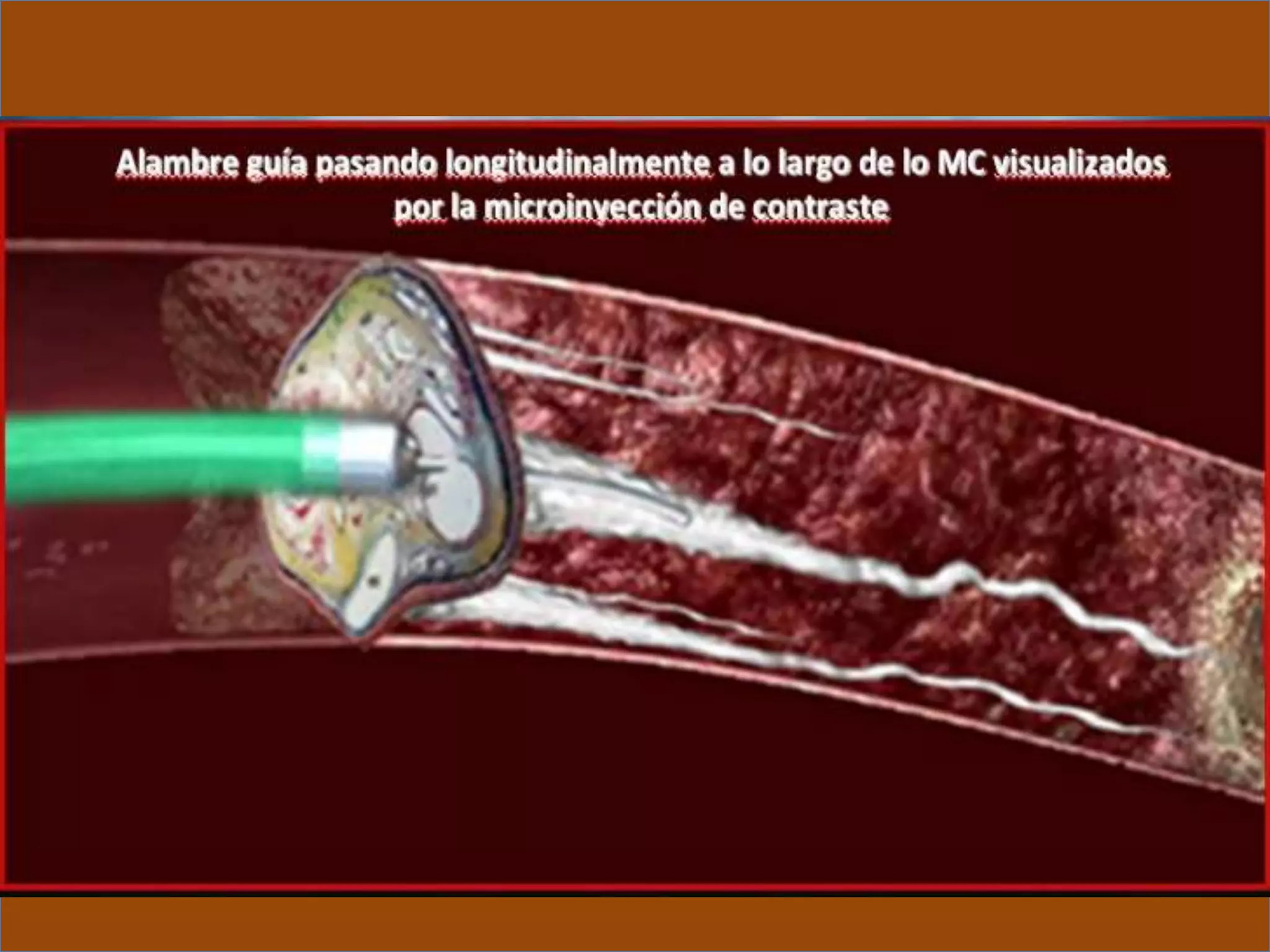 INTERVENTIONAL TECHNIQUES IN CHRONIC TOTAL OCCLUSIONS
