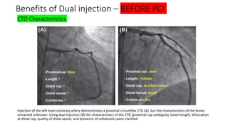 Cto Dual Injection Chronic total ocllusion(cto) dr hafeesh fazulu - pushpagiri - may 14th ...