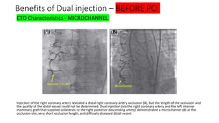 Cto Dual Injection Chronic total ocllusion(cto) dr hafeesh fazulu - pushpagiri - may 14th ...