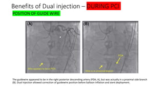 Guide Wire Injection Chronic total ocllusion(cto) dr hafeesh fazulu - pushpagiri - may 14th ...
