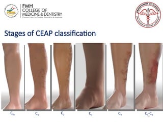 CHRONIC VENOUS DISEASES: A COMMON VENOUS DISORDER | PPT