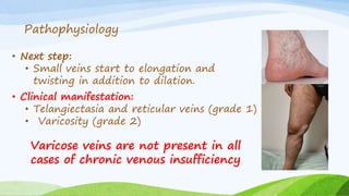 • Next step:
• Small veins start to elongation and
twisting in addition to dilation.
Pathophysiology
• Clinical manifestation:
• Telangiectasia and reticular veins (grade 1)
• Varicosity (grade 2)
Varicose veins are not present in all
cases of chronic venous insufficiency
 