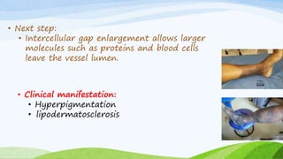 • Next step:
• Intercellular gap enlargement allows larger
molecules such as proteins and blood cells
leave the vessel lumen.
• Clinical manifestation:
• Hyperpigmentation
• lipodermatosclerosis
 