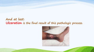 And at last:
Ulceration is the final result of this pathologic process.
 