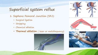 Superficial system reflux
1. Sapheno Femoral Junction (SFJ):
• Surgical ligation
• Stripping
• Chemical ablation
• Thermal ablation ( laser or radiofrequency)
 
