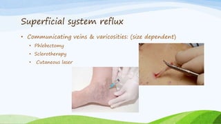 Superficial system reflux
• Communicating veins & varicosities: (size dependent)
• Phlebectomy
• Sclerotherapy
• Cutaneous laser
 