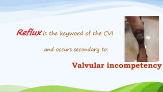 Reflux is the keyword of the CVI
and occurs secondary to:
Valvular incompetency
 