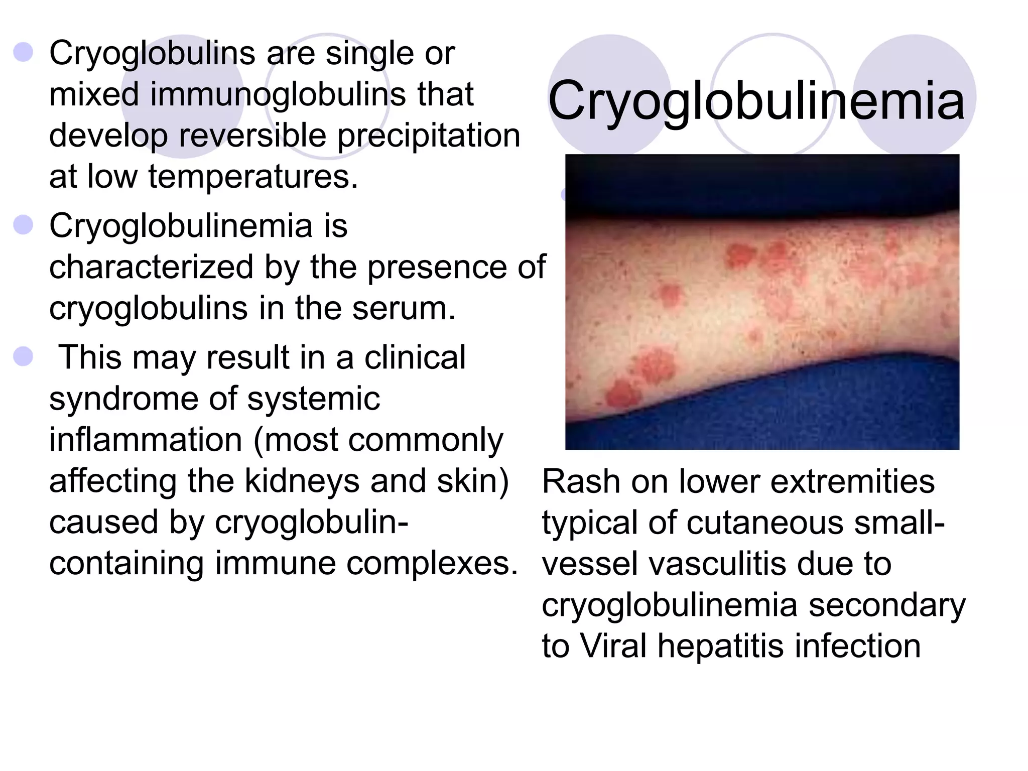 Cryoglobulinemia
 Cryoglobulins are single or
mixed immunoglobulins that
develop reversible precipitation
at low temperatures.
 Cryoglobulinemia is
characterized by the presence of
cryoglobulins in the serum.
 This may result in a clinical
syndrome of systemic
inflammation (most commonly
affecting the kidneys and skin)
caused by cryoglobulin-
containing immune complexes.
 .
Rash on lower extremities
typical of cutaneous small-
vessel vasculitis due to
cryoglobulinemia secondary
to Viral hepatitis infection
 