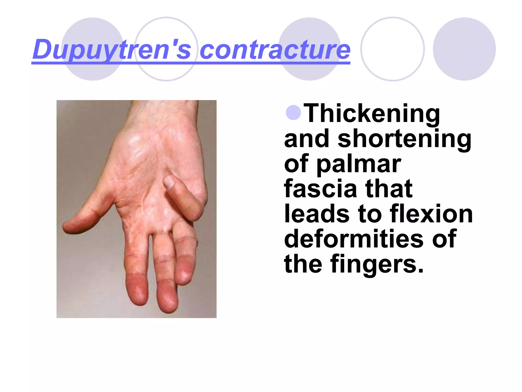 Dupuytren's contracture
Thickening
and shortening
of palmar
fascia that
leads to flexion
deformities of
the fingers.
 
