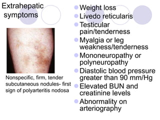 Extrahepatic
symptoms
Weight loss
Livedo reticularis
Testicular
pain/tenderness
Myalgia or leg
weakness/tenderness
Mononeuropathy or
polyneuropathy
Diastolic blood pressure
greater than 90 mm/Hg
Elevated BUN and
creatinine levels
Abnormality on
arteriography
Nonspecific, firm, tender
subcutaneous nodules- first
sign of polyarteritis nodosa
 