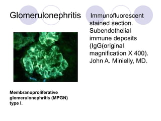 Glomerulonephritis Immunofluorescent
stained section.
Subendothelial
immune deposits
(IgG(original
magnification X 400).
John A. Minielly, MD.
Membranoproliferative
glomerulonephritis (MPGN)
type I.
 